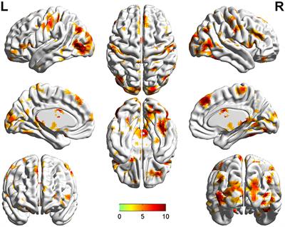 Distinguishing Between Treatment-Resistant and Non-Treatment-Resistant Schizophrenia Using Regional Homogeneity